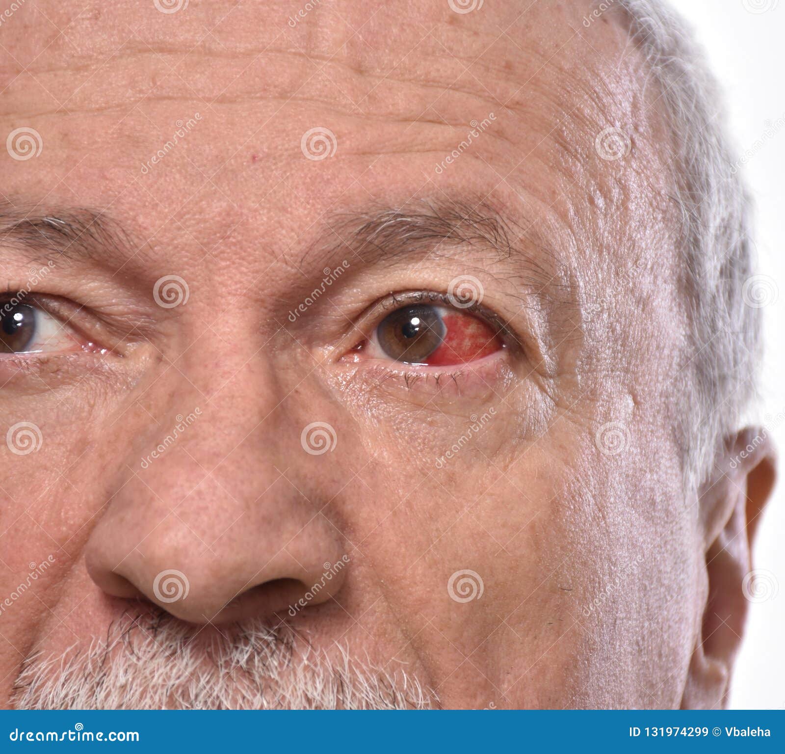 Senior man with irritated red bloodshot eye on a white background