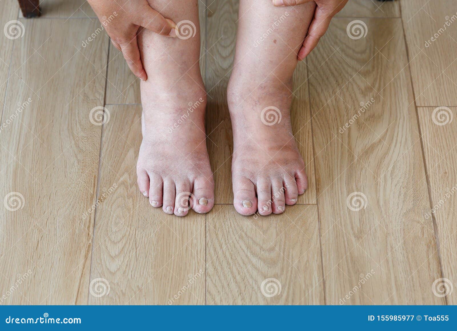 senior woman swollen feet and leg