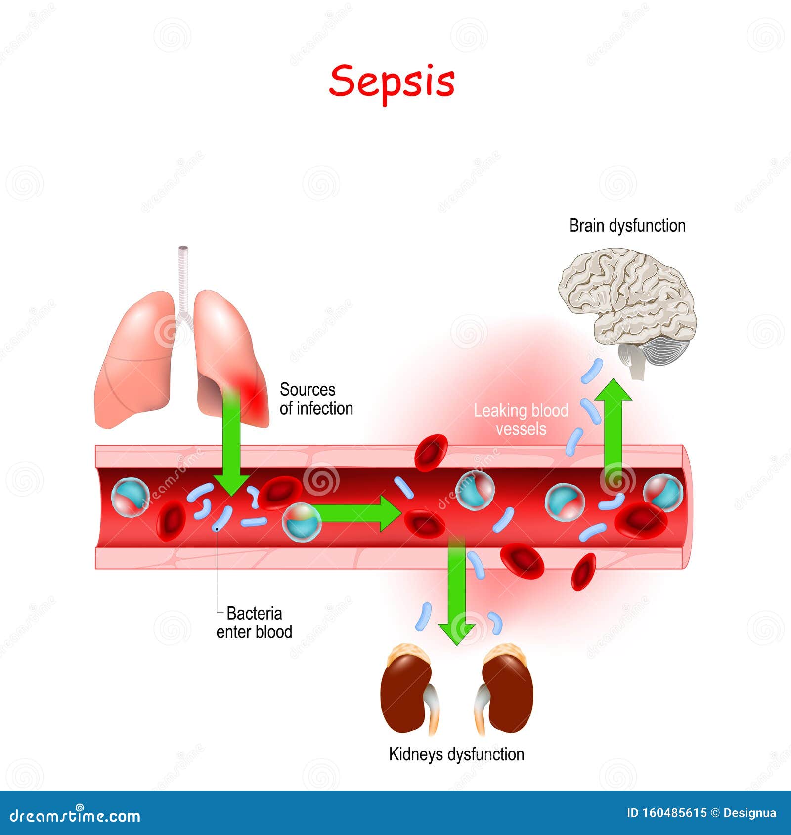 prostatita cu sepsis