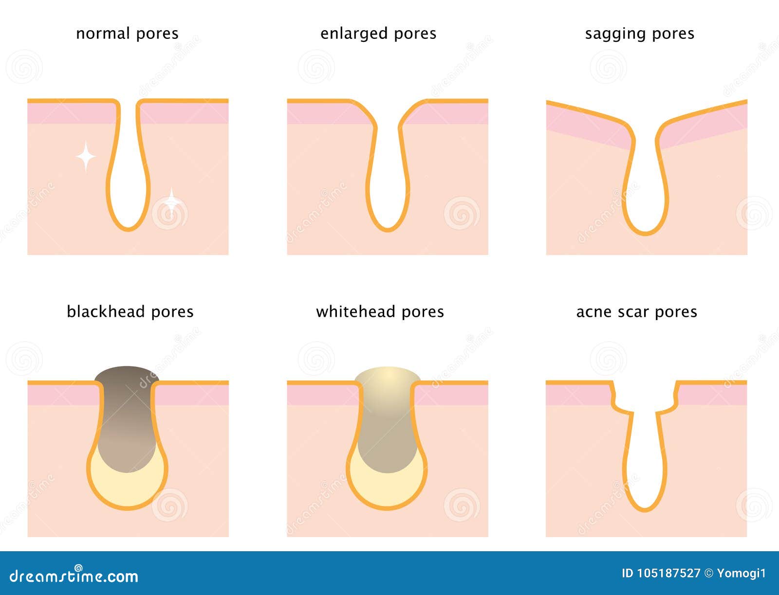set of skin pores: normal, sagging, enlarged, blackhead, whitehead and acne scar
