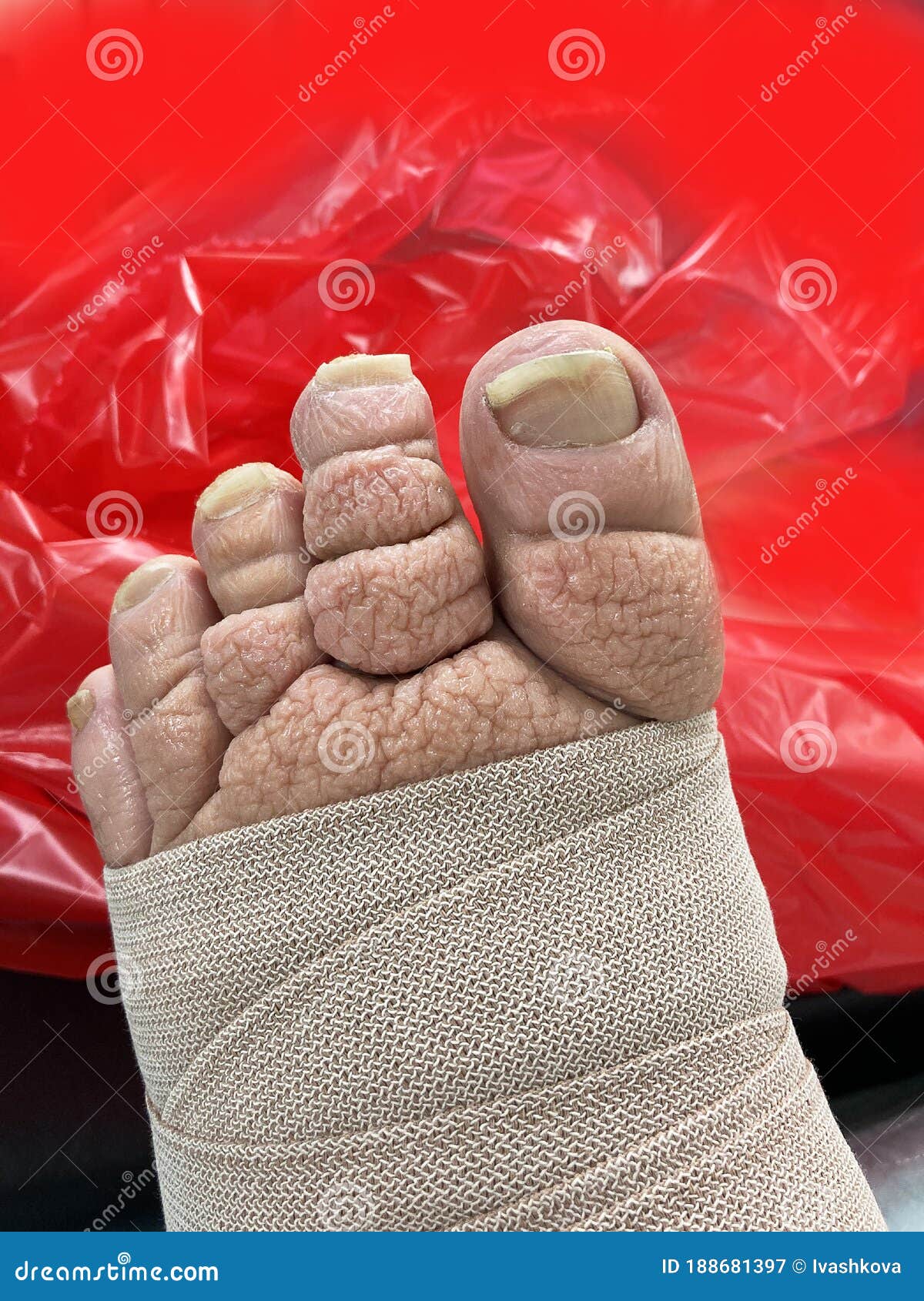 Severe Lymphedema, a Medical Condition Stock Image Image of condition