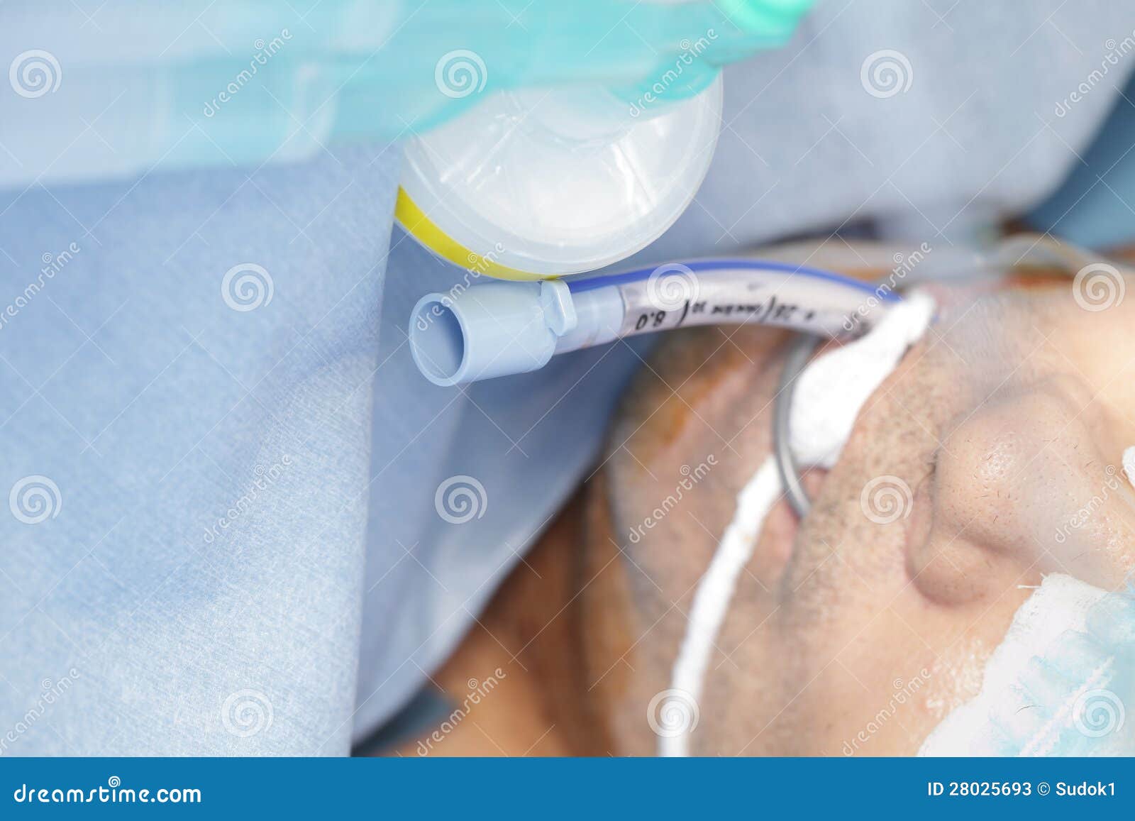 Severe Patients With Endotracheal Tube Stock Photos Image 28025693