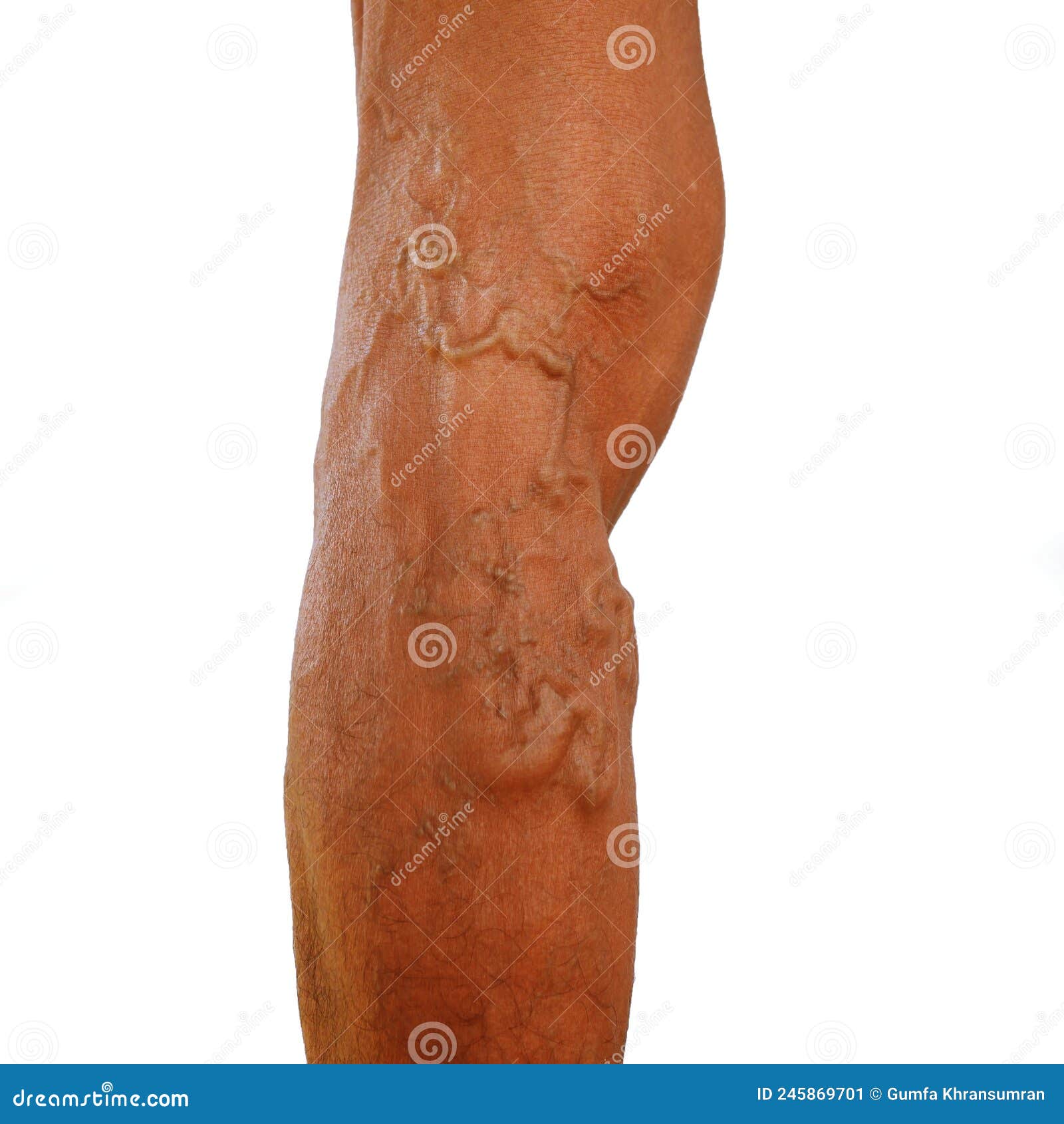 the severity of the varicose veins ranges from the tiny.