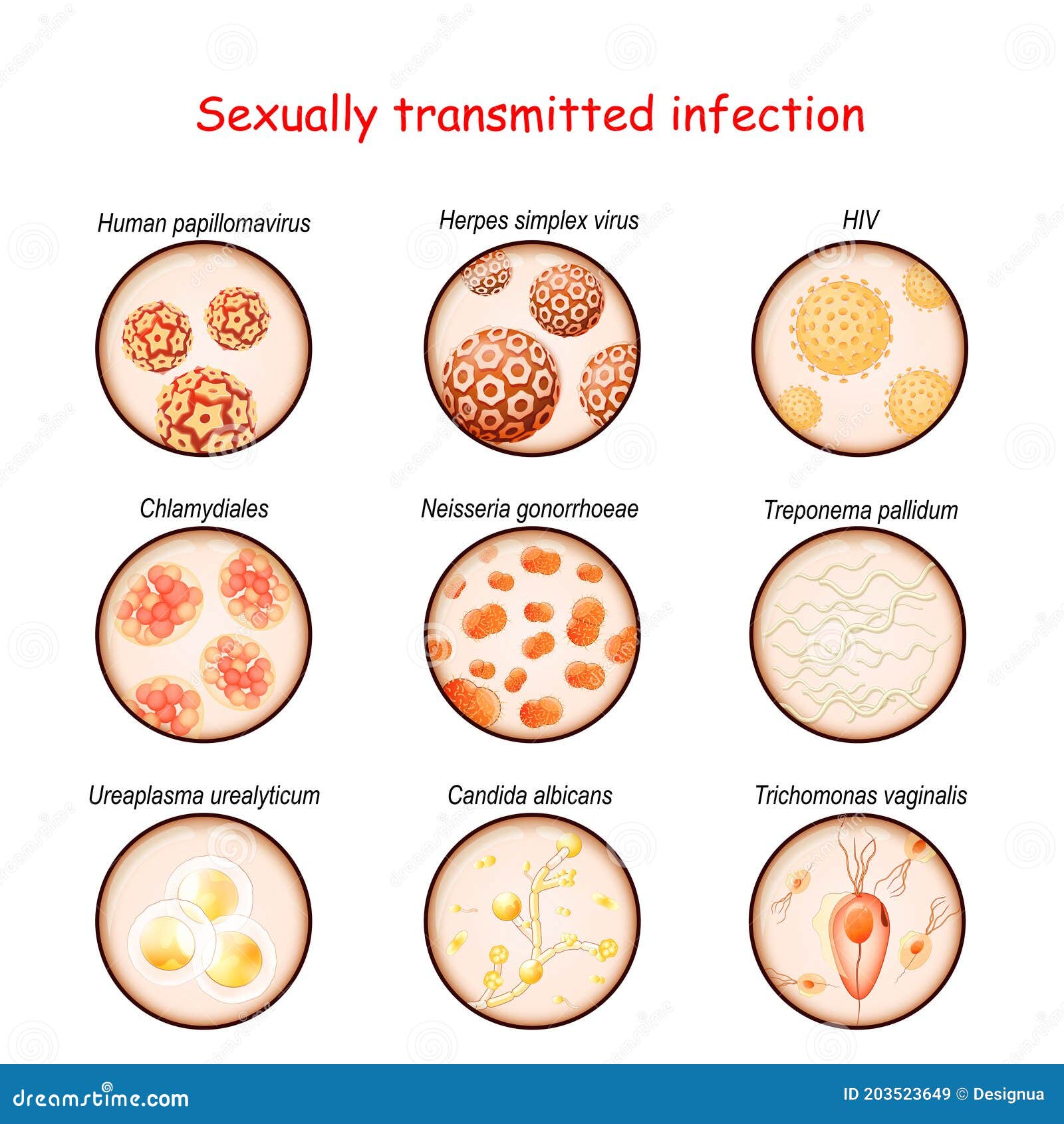 Trichomonas diplococci)