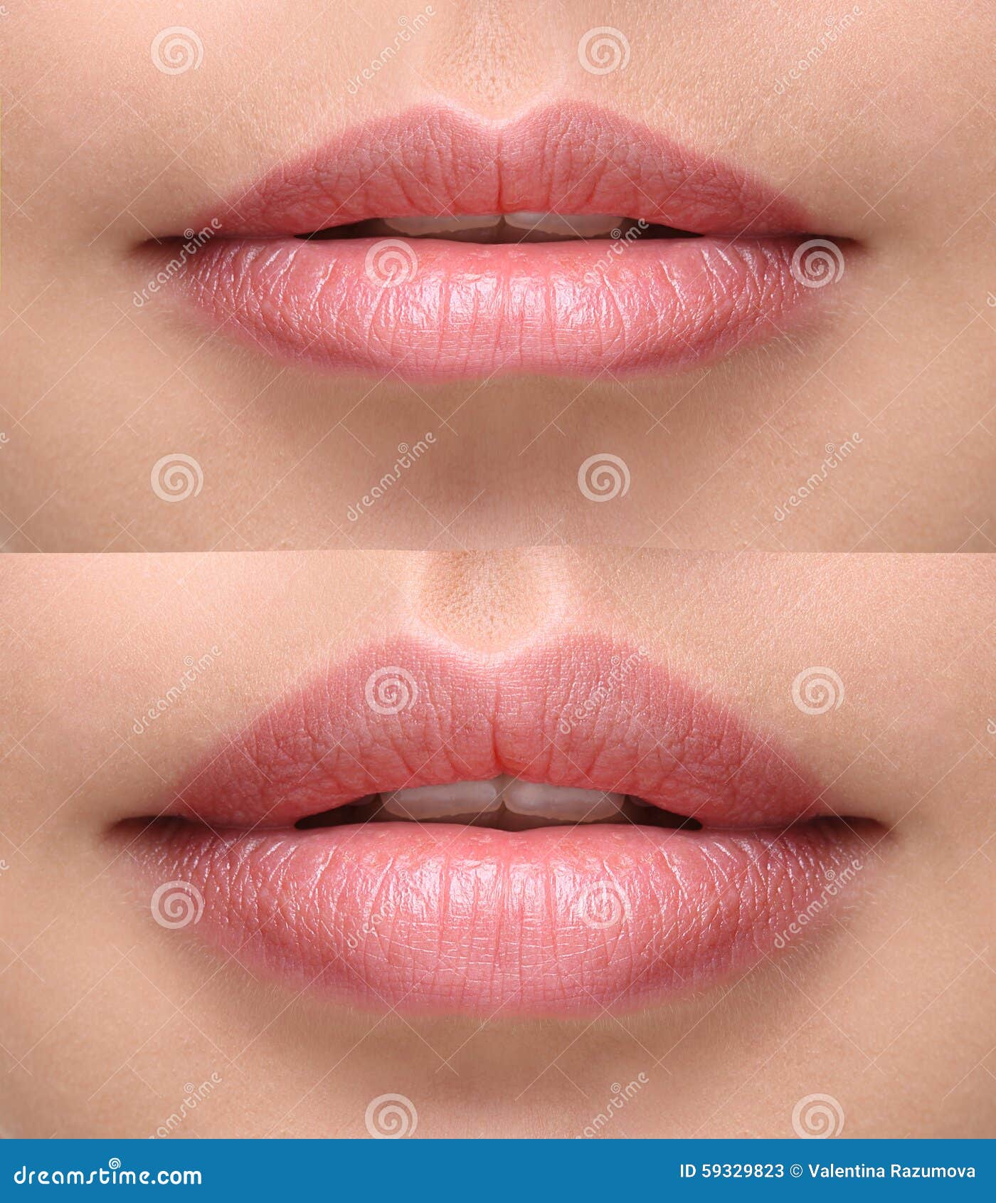 plump lips after filler injection