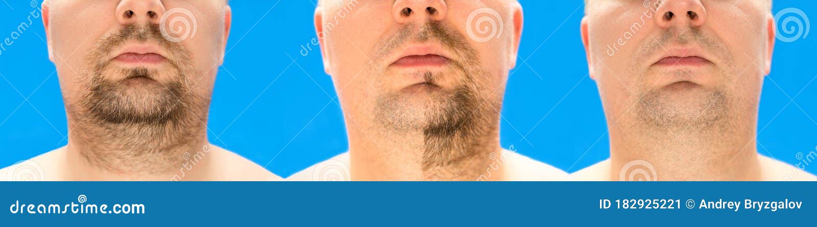 Before and after Shaving. Collage of Young Man with Unformed, Untrimmed, Overgrown Stubble, Hair on His Face and Neck, Half and Stock Image - Image of beard, neck: 182925221 Before and after Shaving. Collage of Young Man with Unformed, Untrimmed, Overgrown Stubble, Hair on His Face and Neck, Half and Stock Image - Image of beard, neck: 182925221