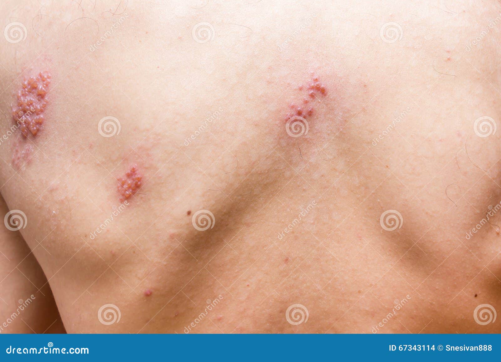 shingles on men herpes zoster. closeup.