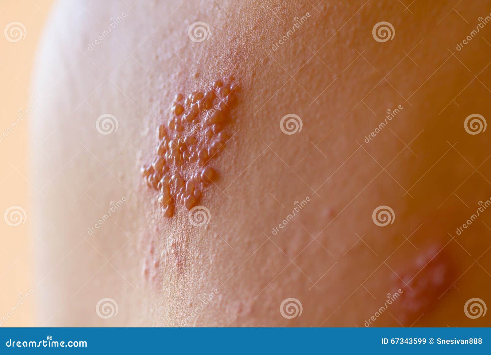 shingles on men herpes zoster. closeup.