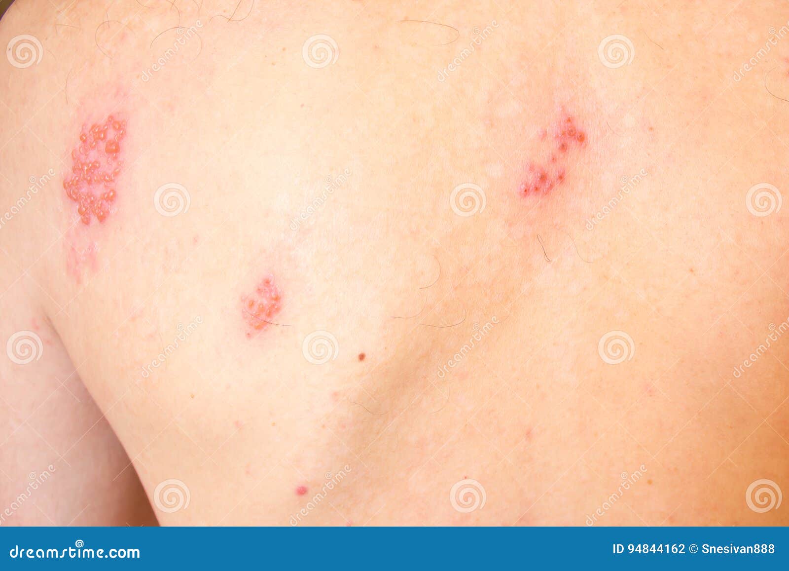 shingles on men herpes zoster. closeup.