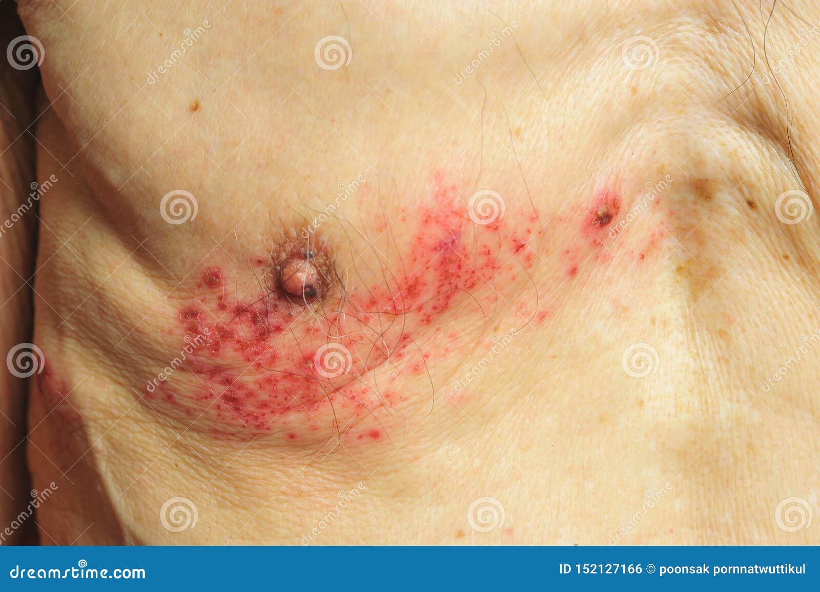 Shingles Is A Viral Infection That Causes A Painful Rash Stock Photo