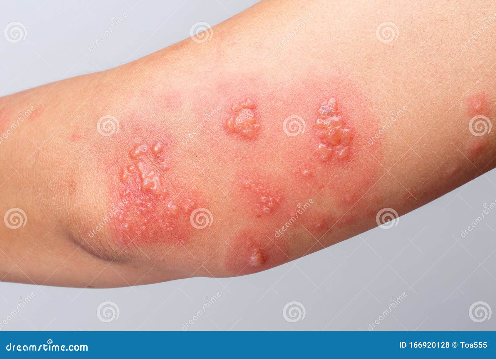 shingles, zoster or herpes zoster symptoms on arm