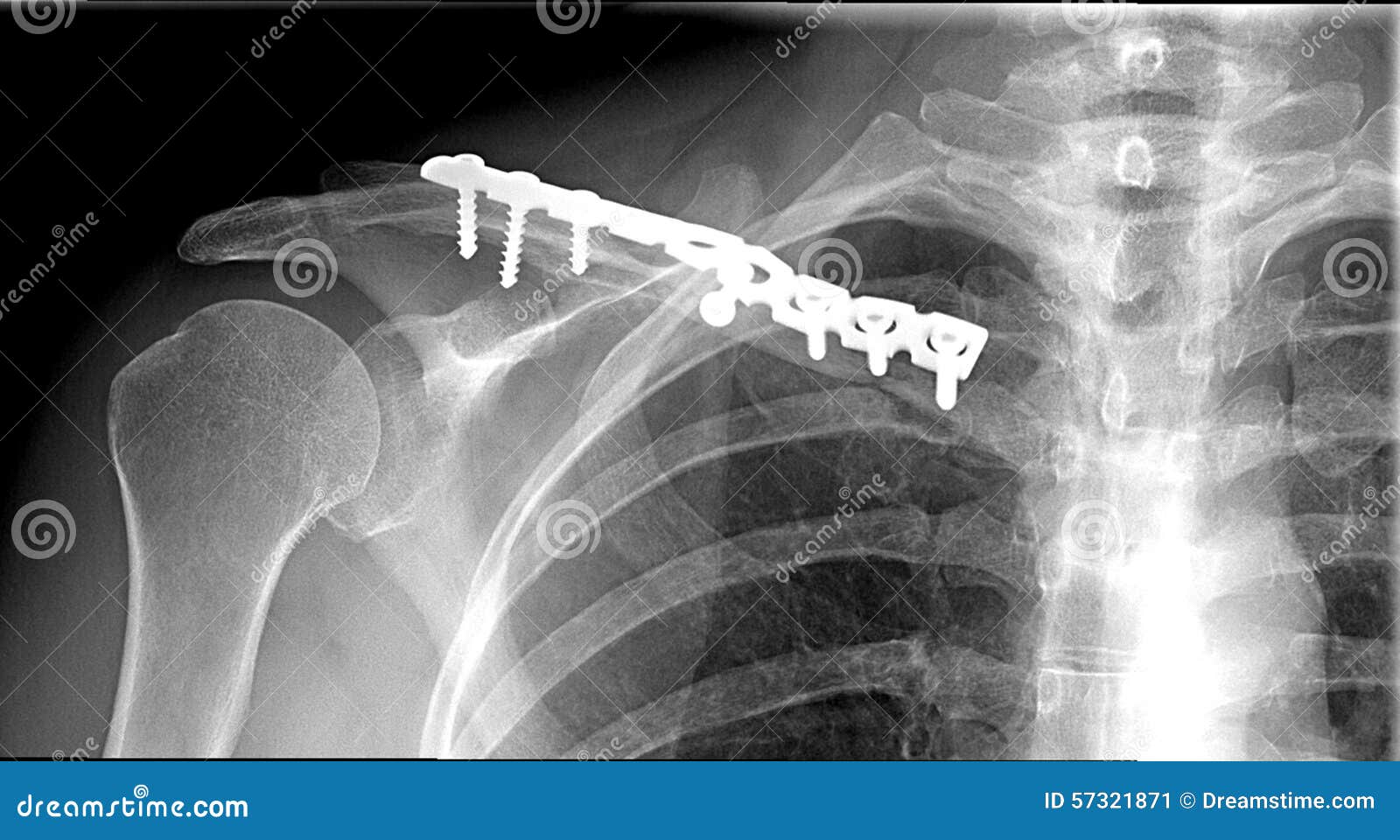 锁骨中段粉碎性骨折S型锁定钢板固定 - 病例中心(诊疗助手) - 爱爱医医学网