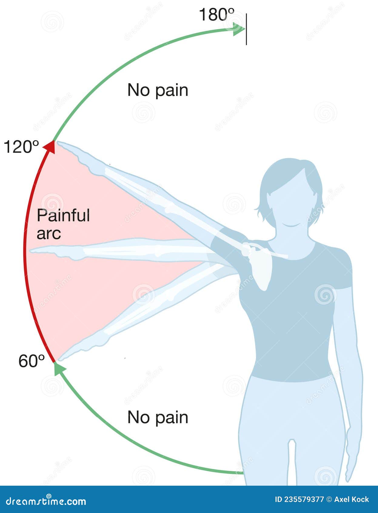 What Is Shoulder Impingement Syndrome Is Impingement - vrogue.co