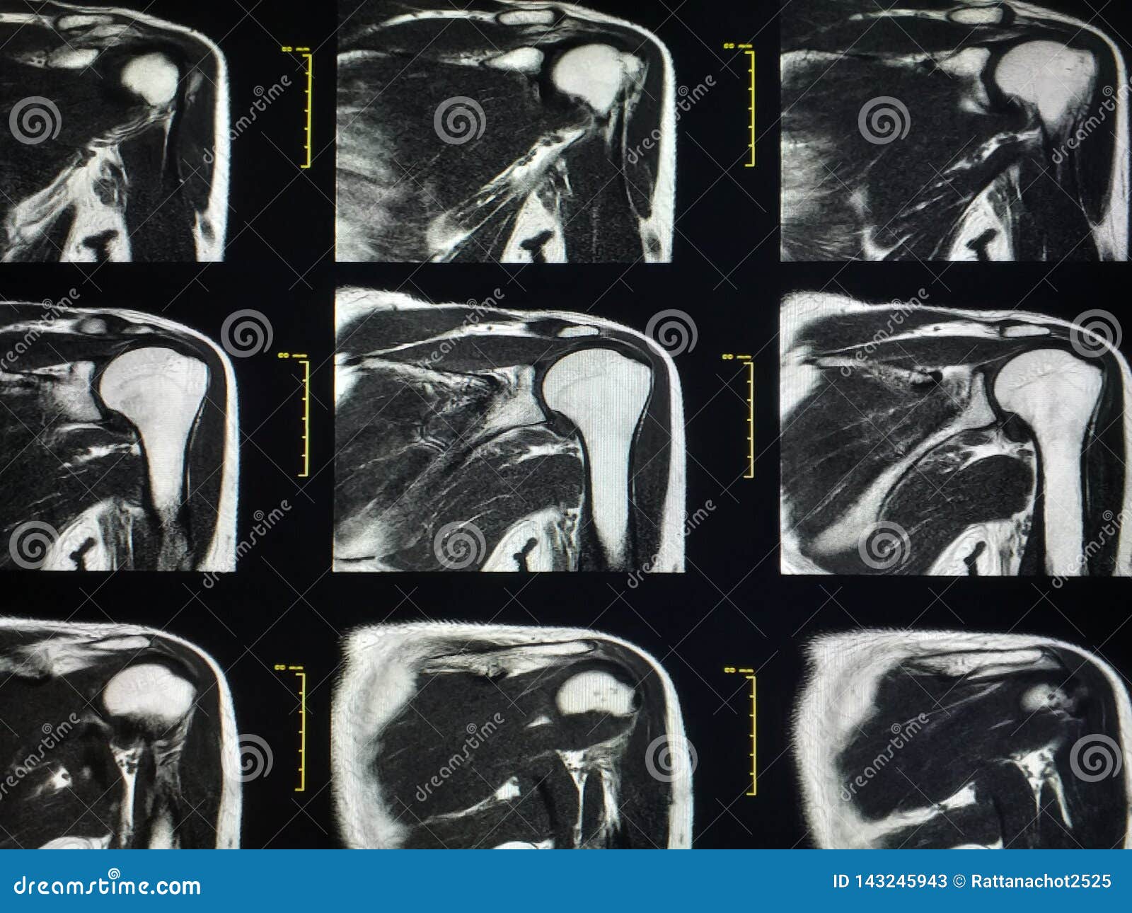 A Shoulder To Cry On Scan Shoulder MRI Scan Magnetic Resonance Image High Resolution Stock Image