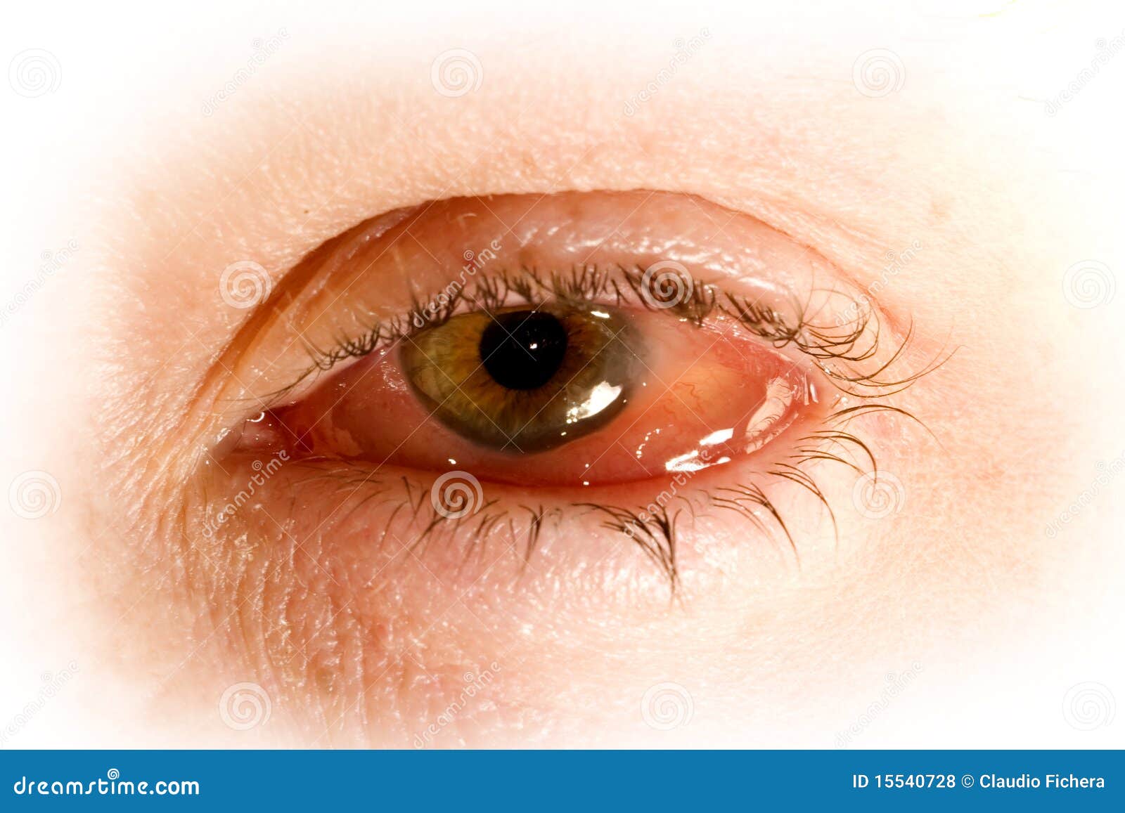 Sick Eye with Conjunctivitis Stock Photo - Image of allergy, cold: 15540728