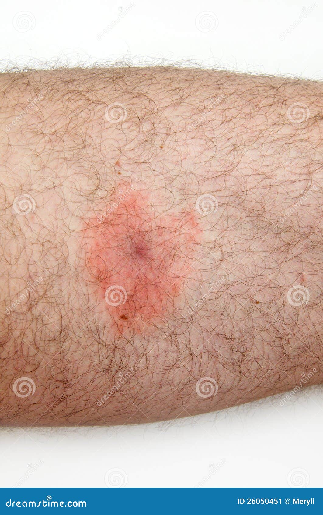 Sick man, lyme disease. Man infected by lyme disease, detail of red spot on his skin.