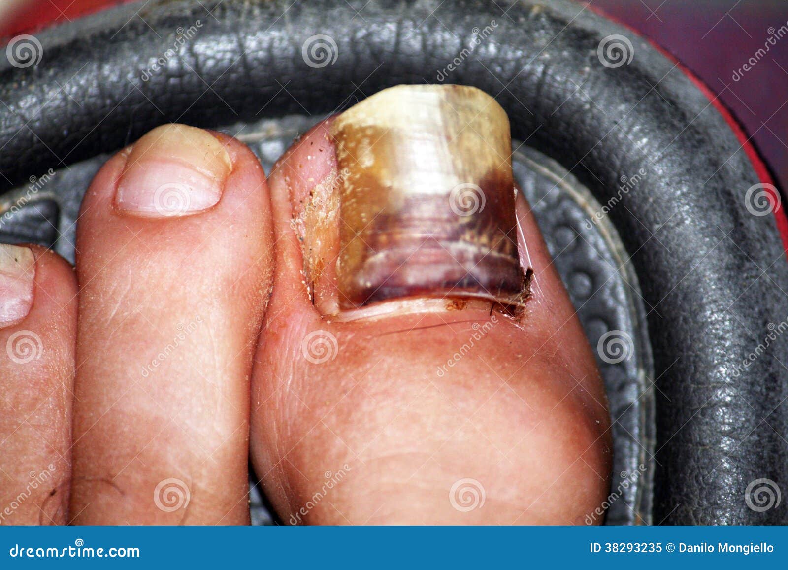 Sick nail stock image. Image of nails, body, danger, nail 38293235