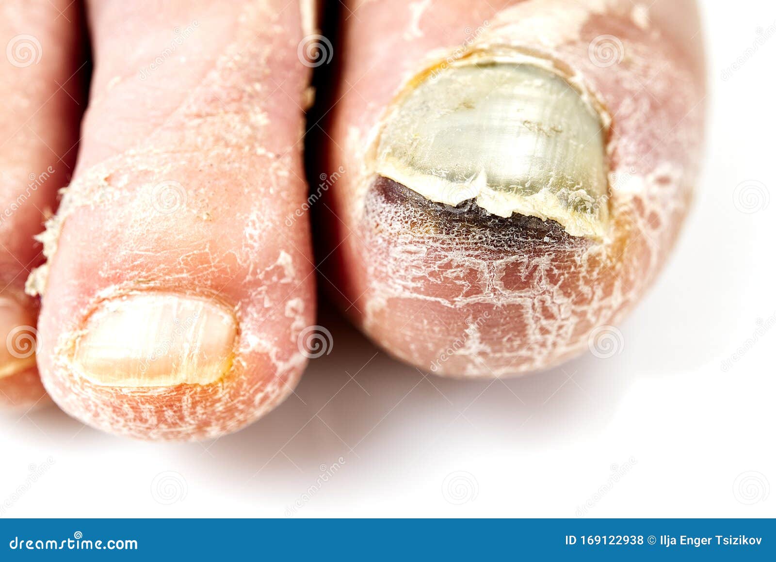 Laser Treatment for Fungal Toenails- Lunula- no side effects | A&A  Podiatrists & Chiropodists