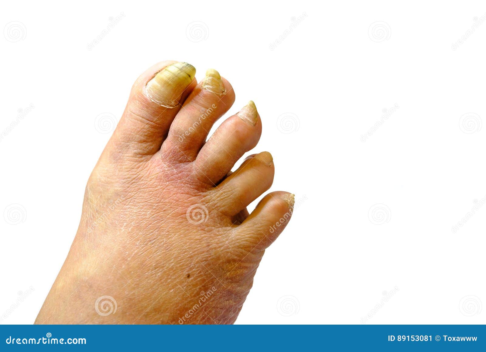 Sick Unhealthy Nails on the Foot of a Man Stock Image Image of