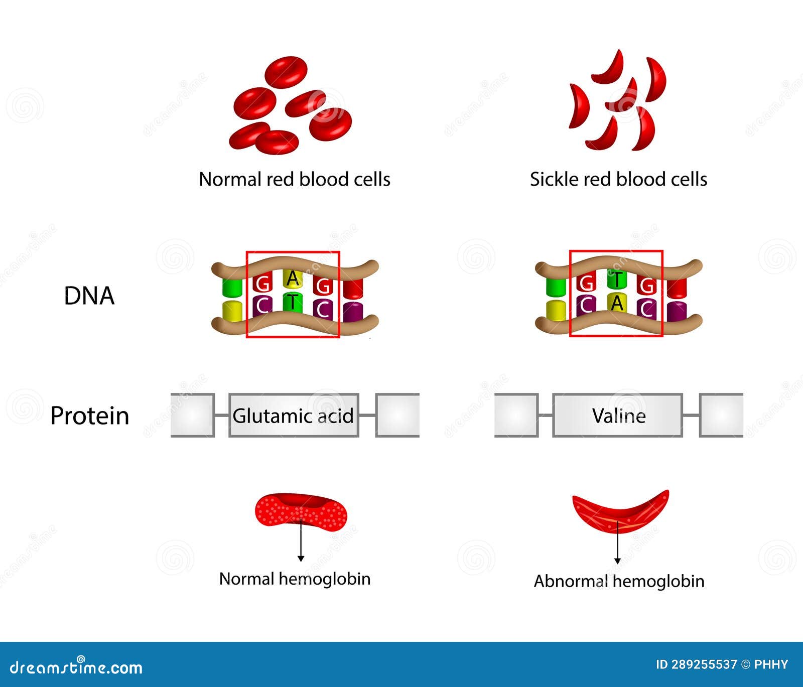 sickle cell anemia, disease. normal and sickled red blood cells.