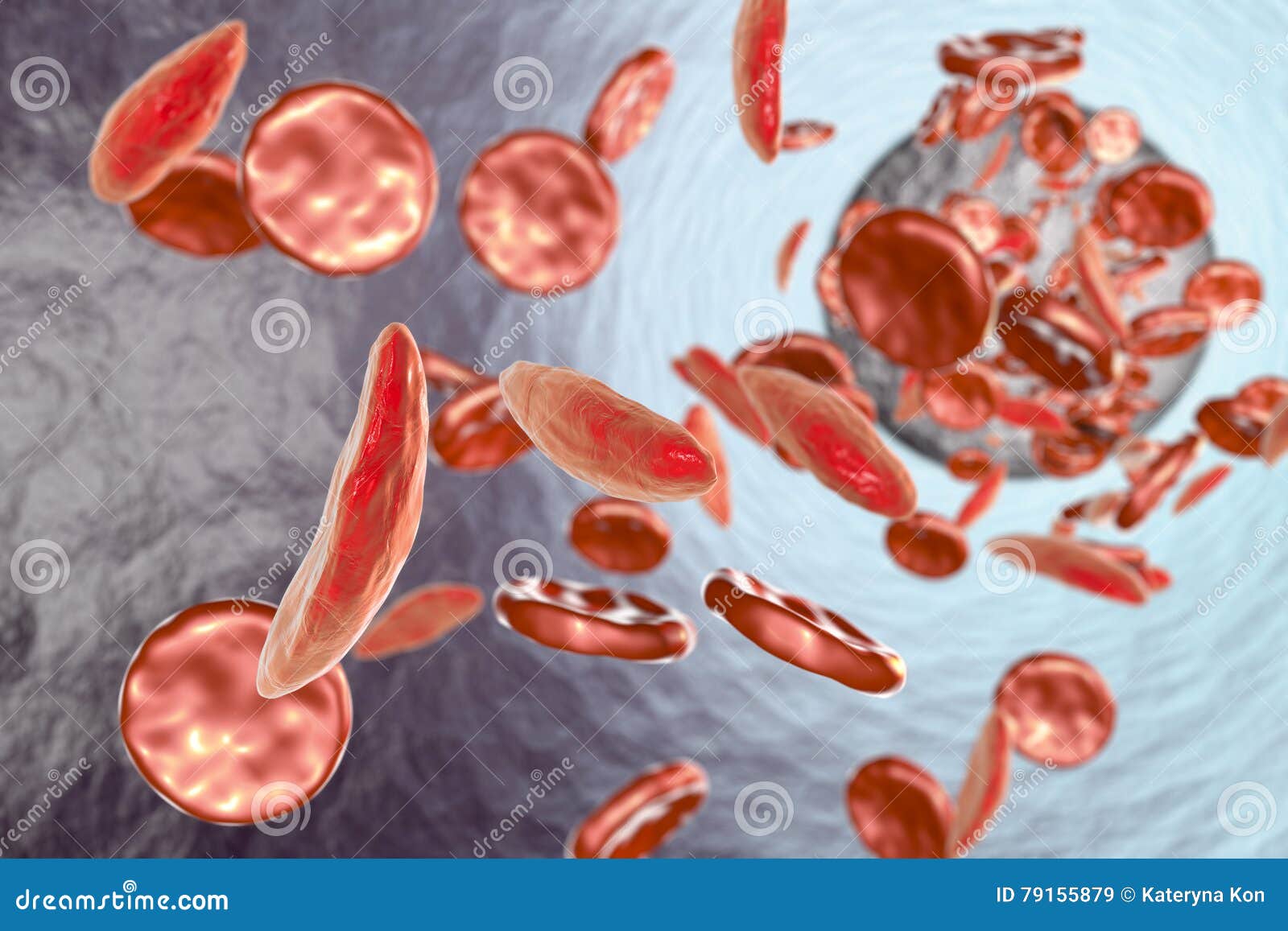 sickle cell anemia