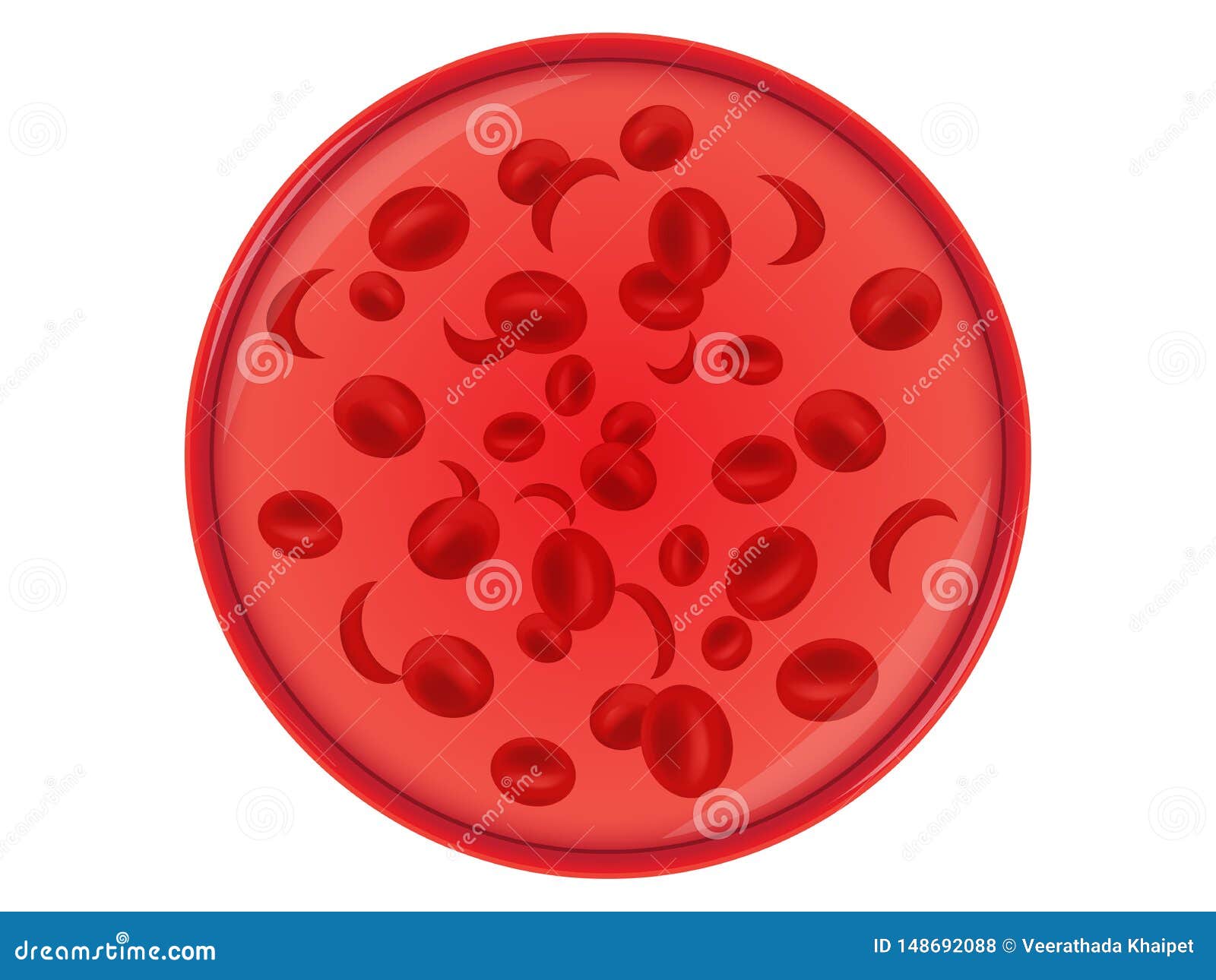 sickle cell anemia