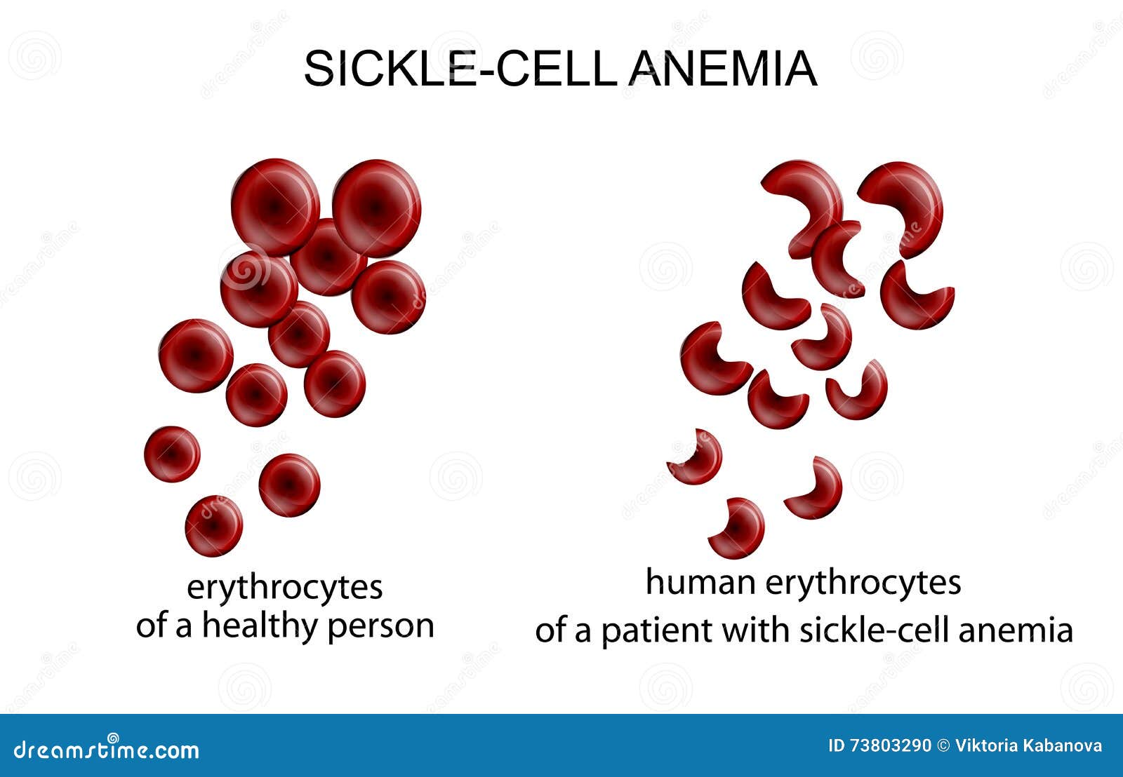 sickle cell anemia