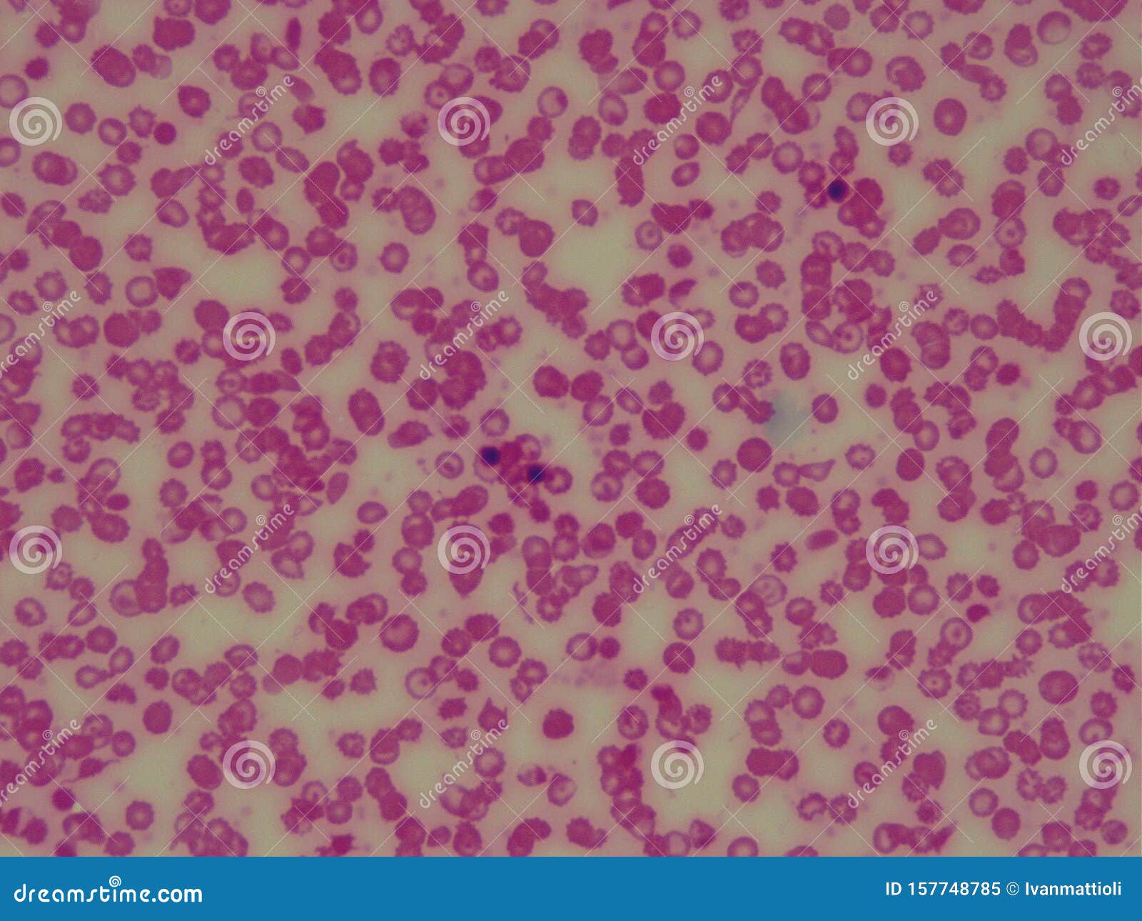 sickle cell anemic blood under microscope. red blood cells