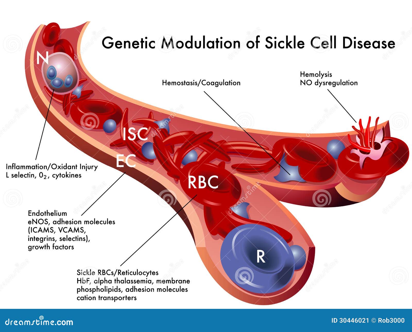 sickle cell disease