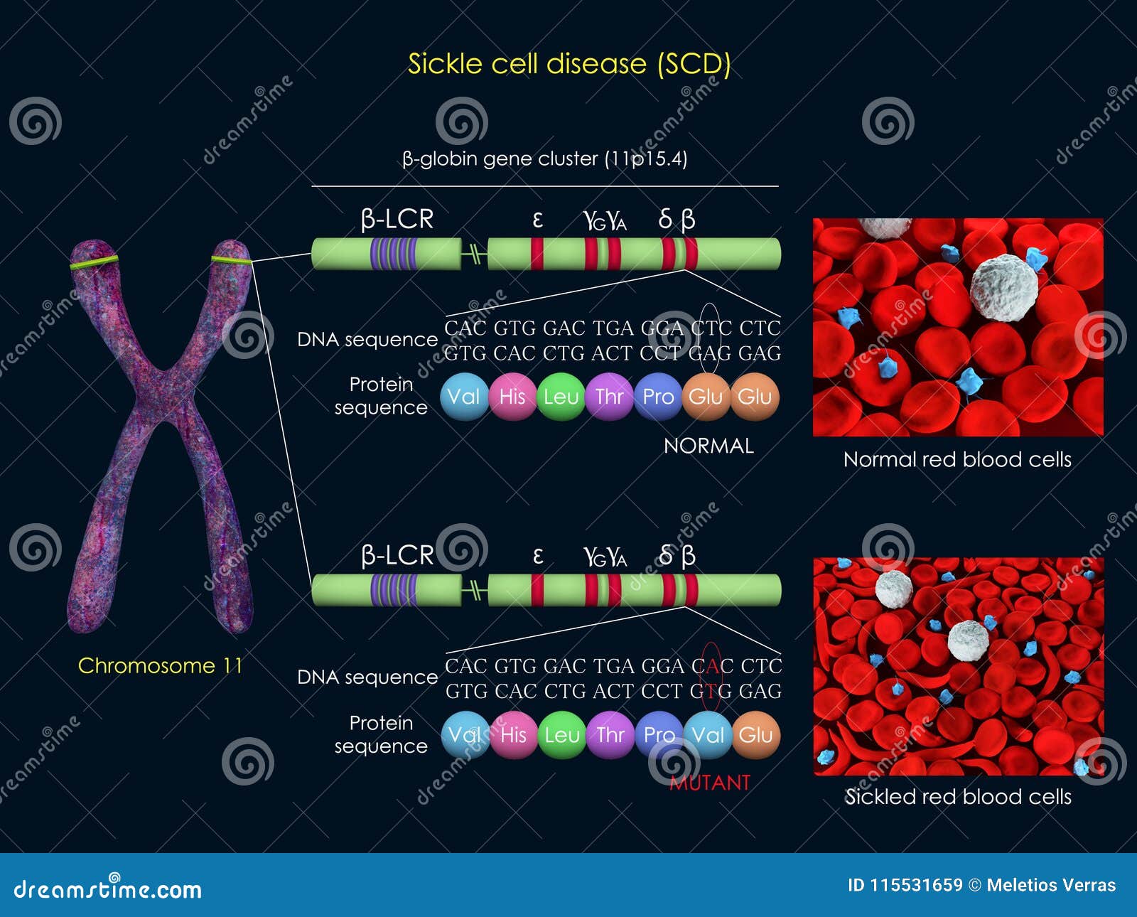 sickle cell disease mutation