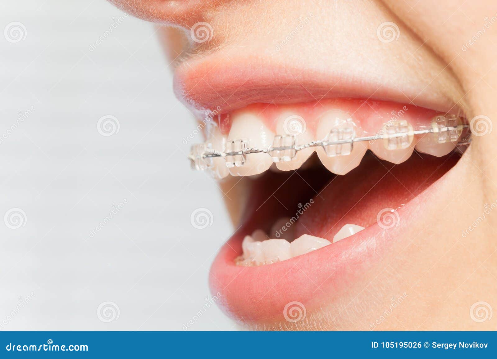 orthodontics correction of jaws with clear bracket