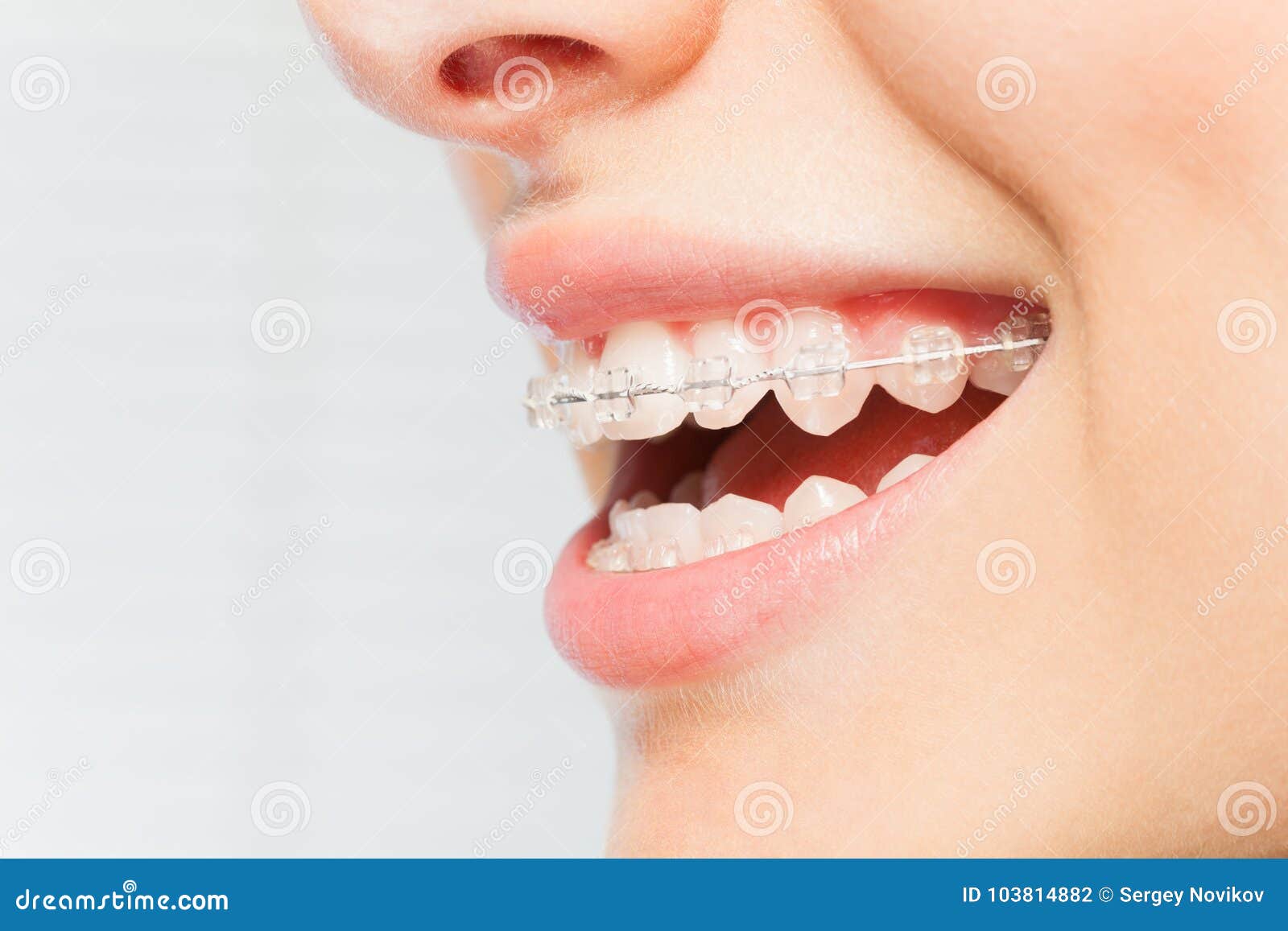 woman`s smile with clear dental braces on teeth