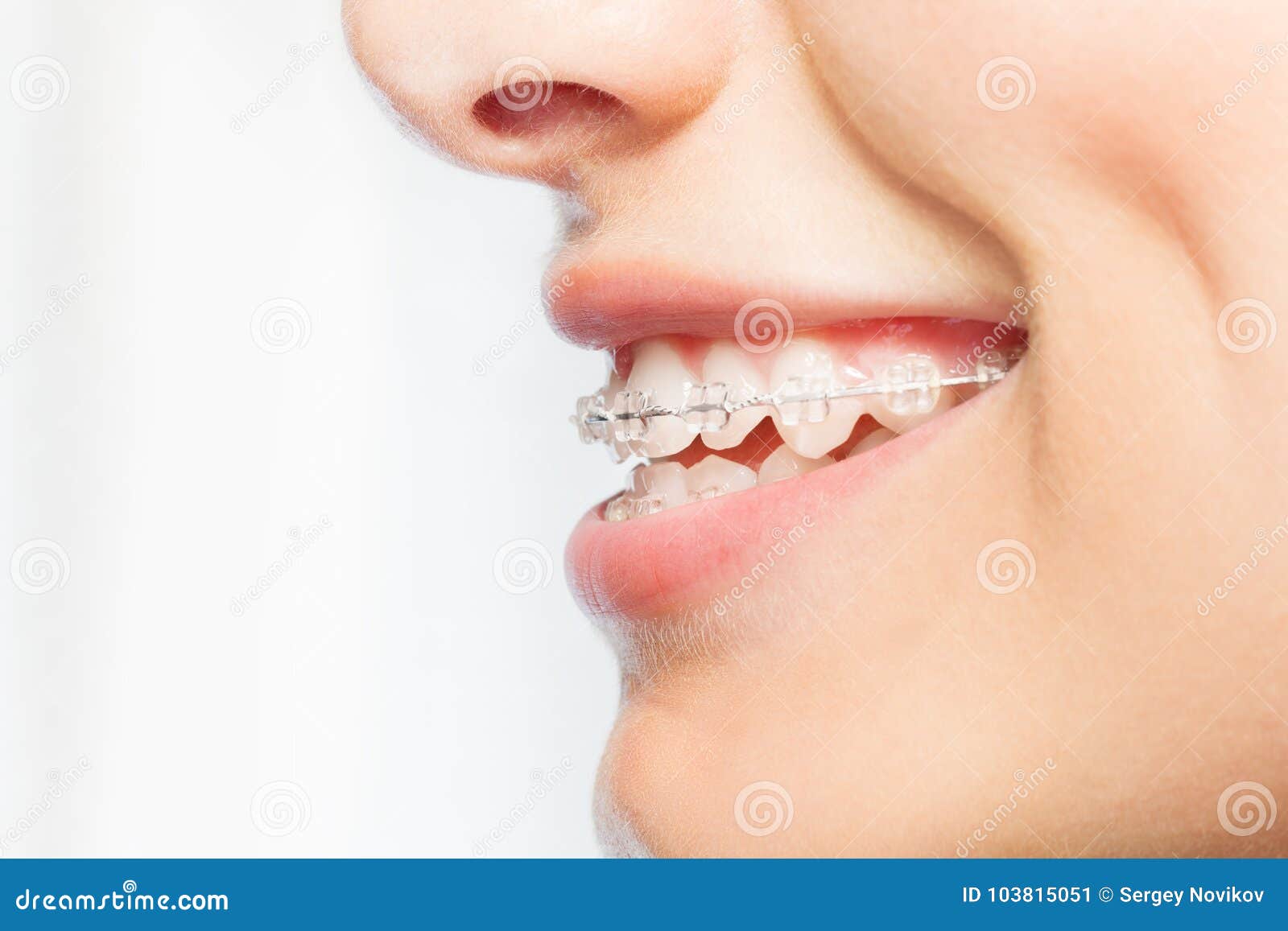 side view picture of woman smile with clear braces