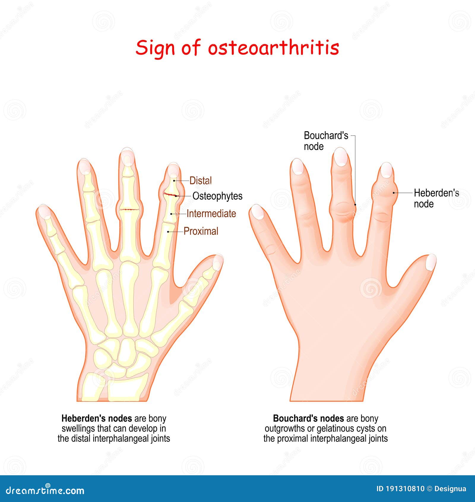 https://thumbs.dreamstime.com/z/sign-osteoarthritis-human-hand-heberden-s-node-bouchard-s-node-sign-osteoarthritis-human-hand-heberden-s-node-191310810.jpg