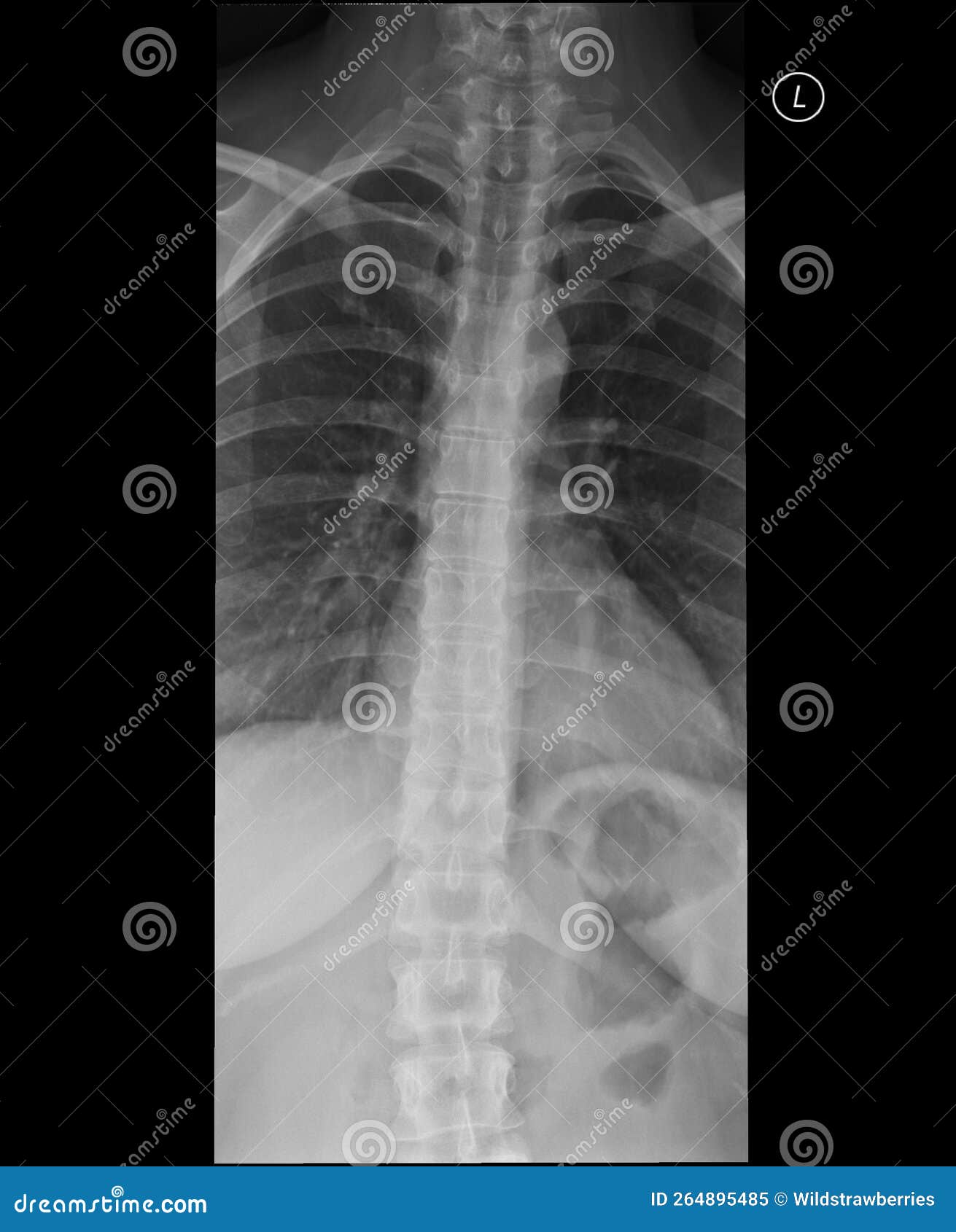 thoracic spine x-ray. anteroposterior view.