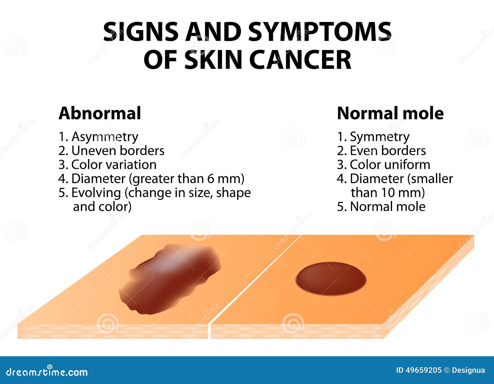 Skin Cancer Abcde Chart