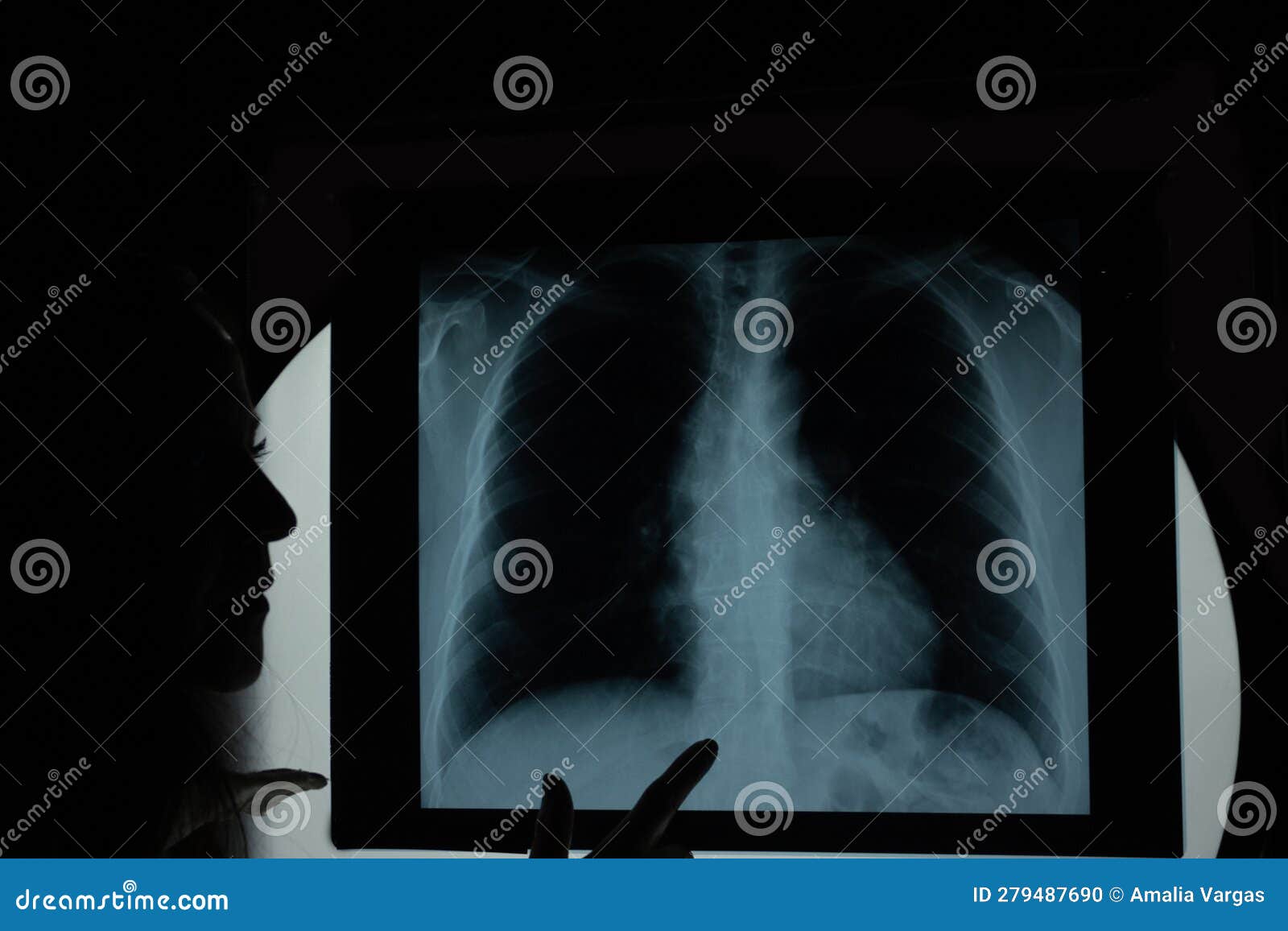 post anterior chest x-ray showing lung parenchyma homogeneous radiographic pattern and aortic button prominence reviewing by