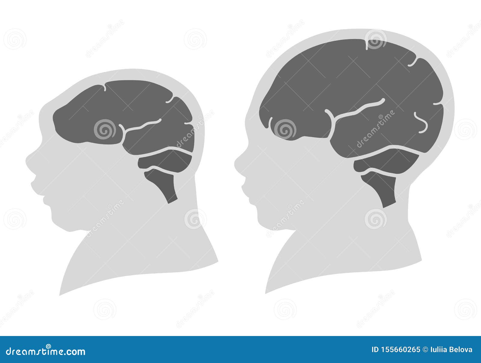 silhouette image of the head and skull of a newborn child with a normal cranium and with microcephaly and severe microcephaly.