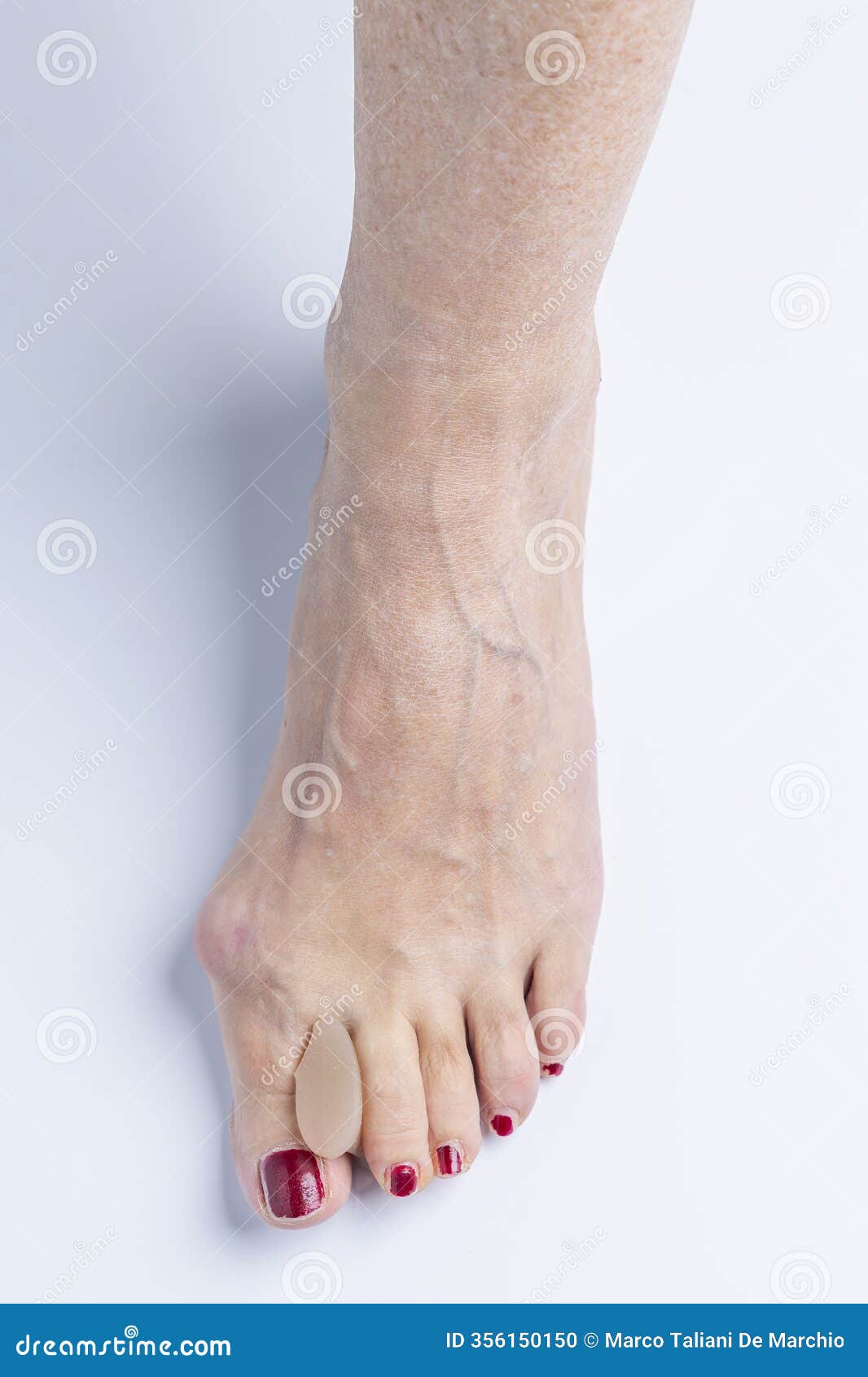 a silicone separator inserted between the big toe and index toe of a foot with hallux valgus
