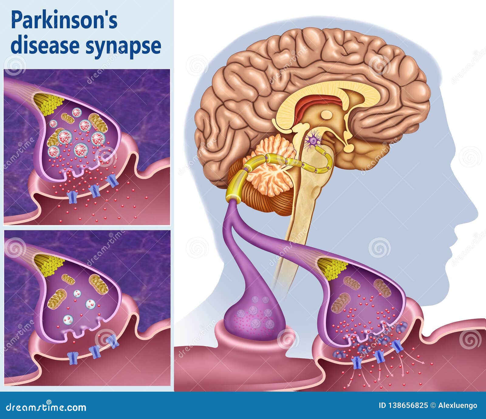 sinapsis de dopamina en el mal de parkinson