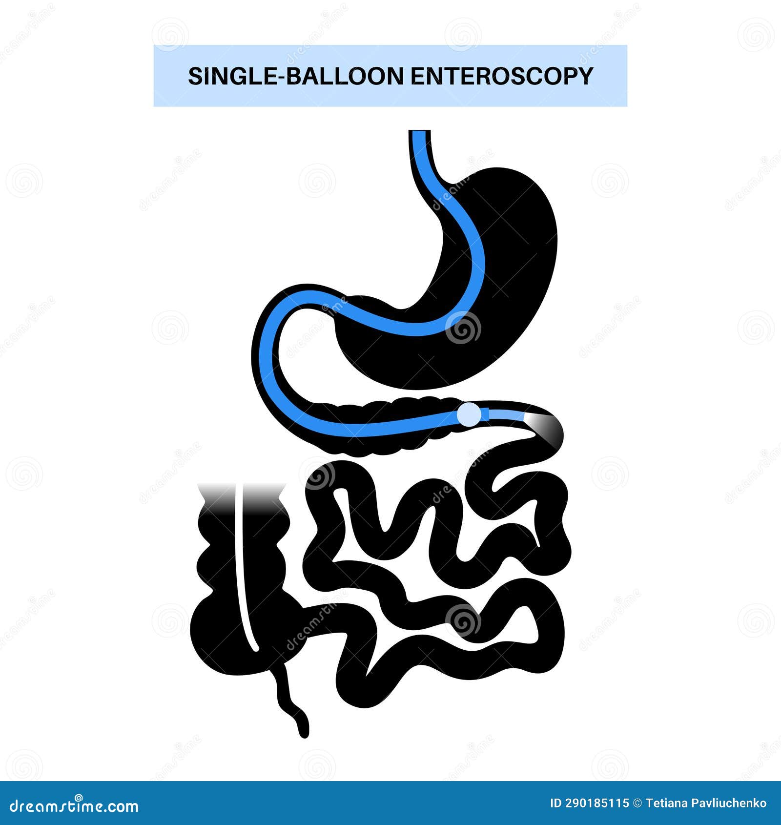 single balloon enteroscopy