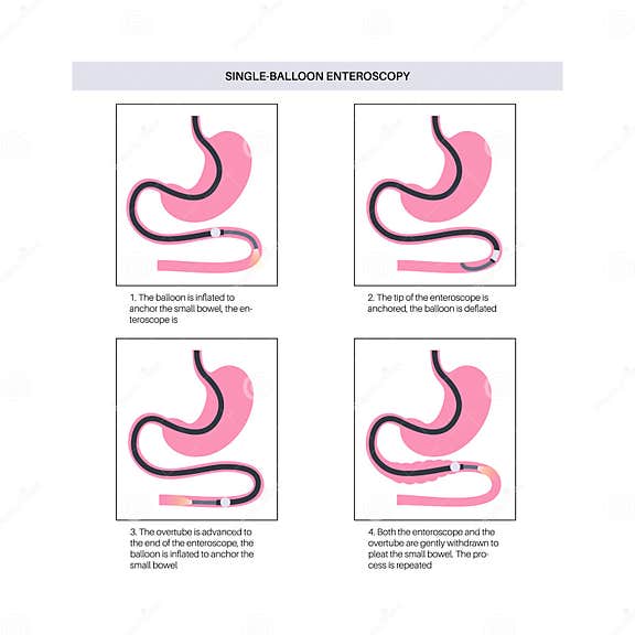 Single balloon enteroscopy stock illustration. Illustration of