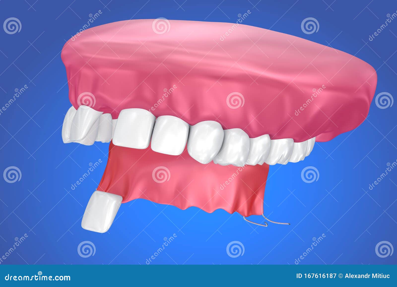 single missing tooth - removable partial denture