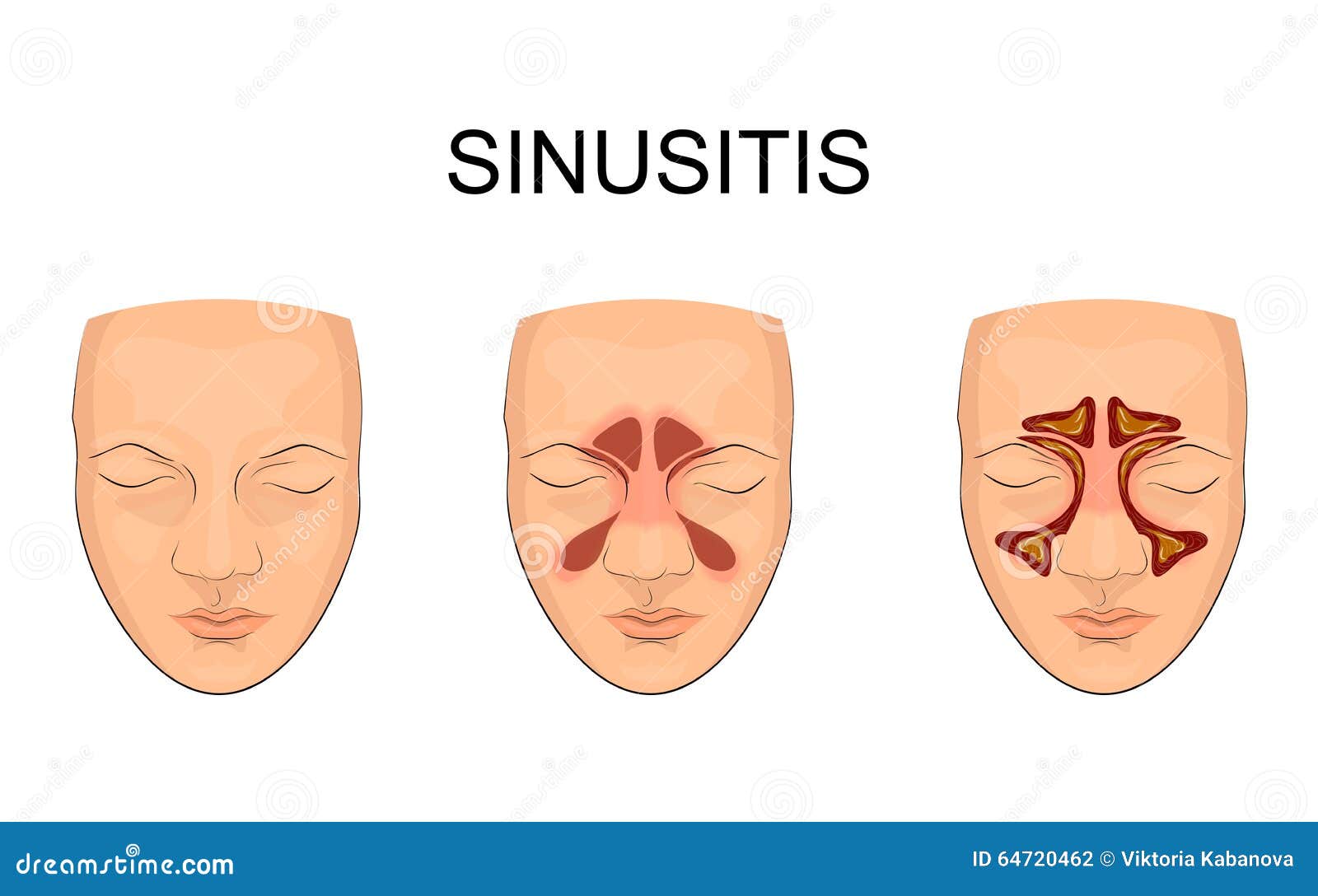 Sinus nasal inflammation illustration de vecteur. Illustration du