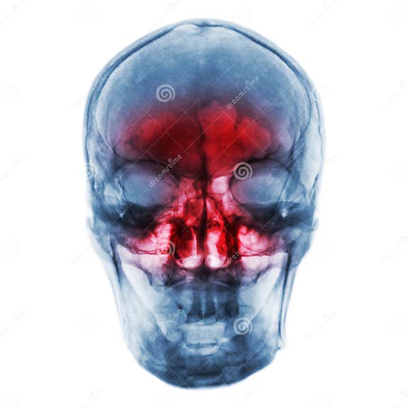 Sinusitis Filmröntgenstraal Van Menselijke Schedel Met Ontstoken Bij ...