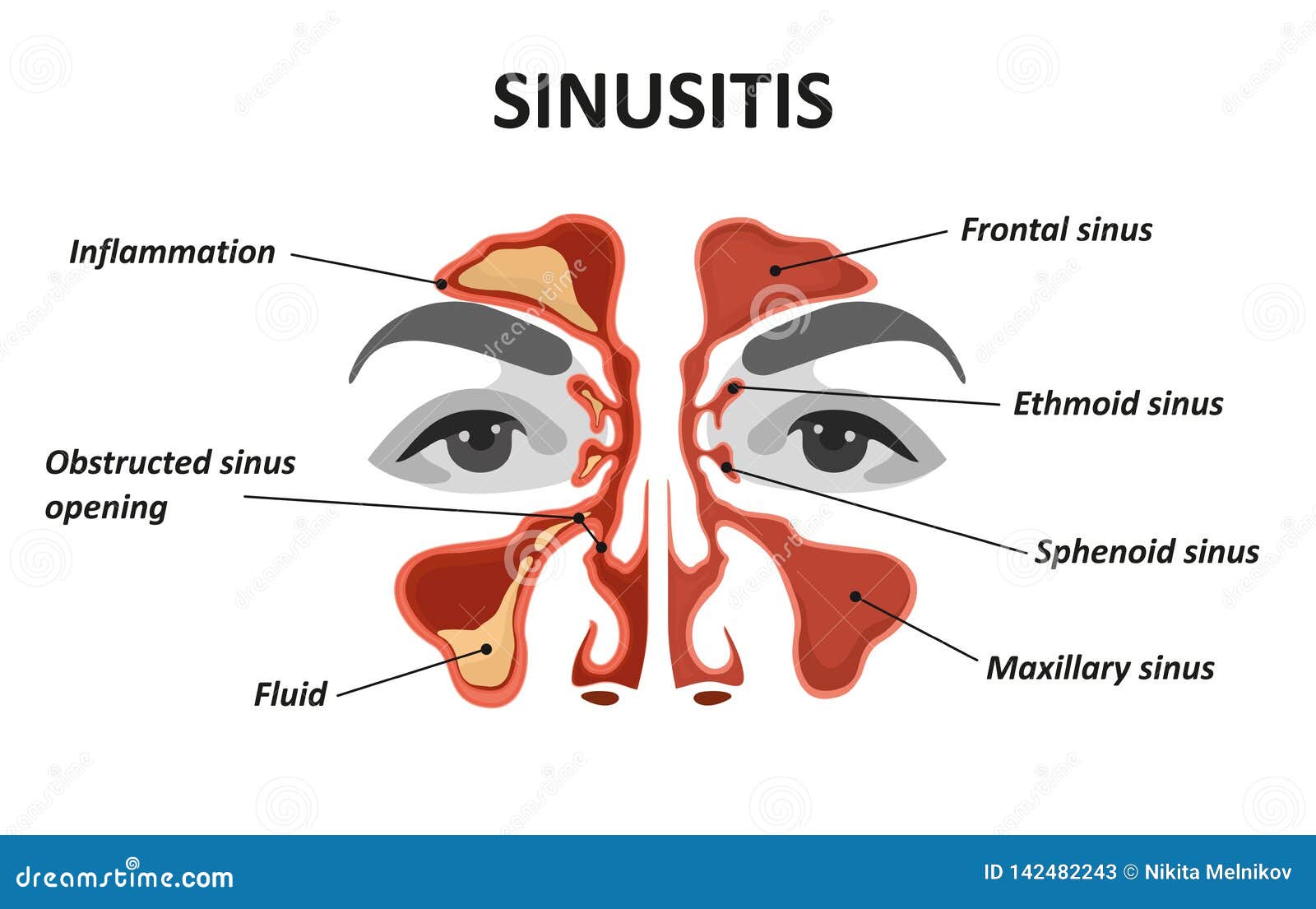 sinusitis.