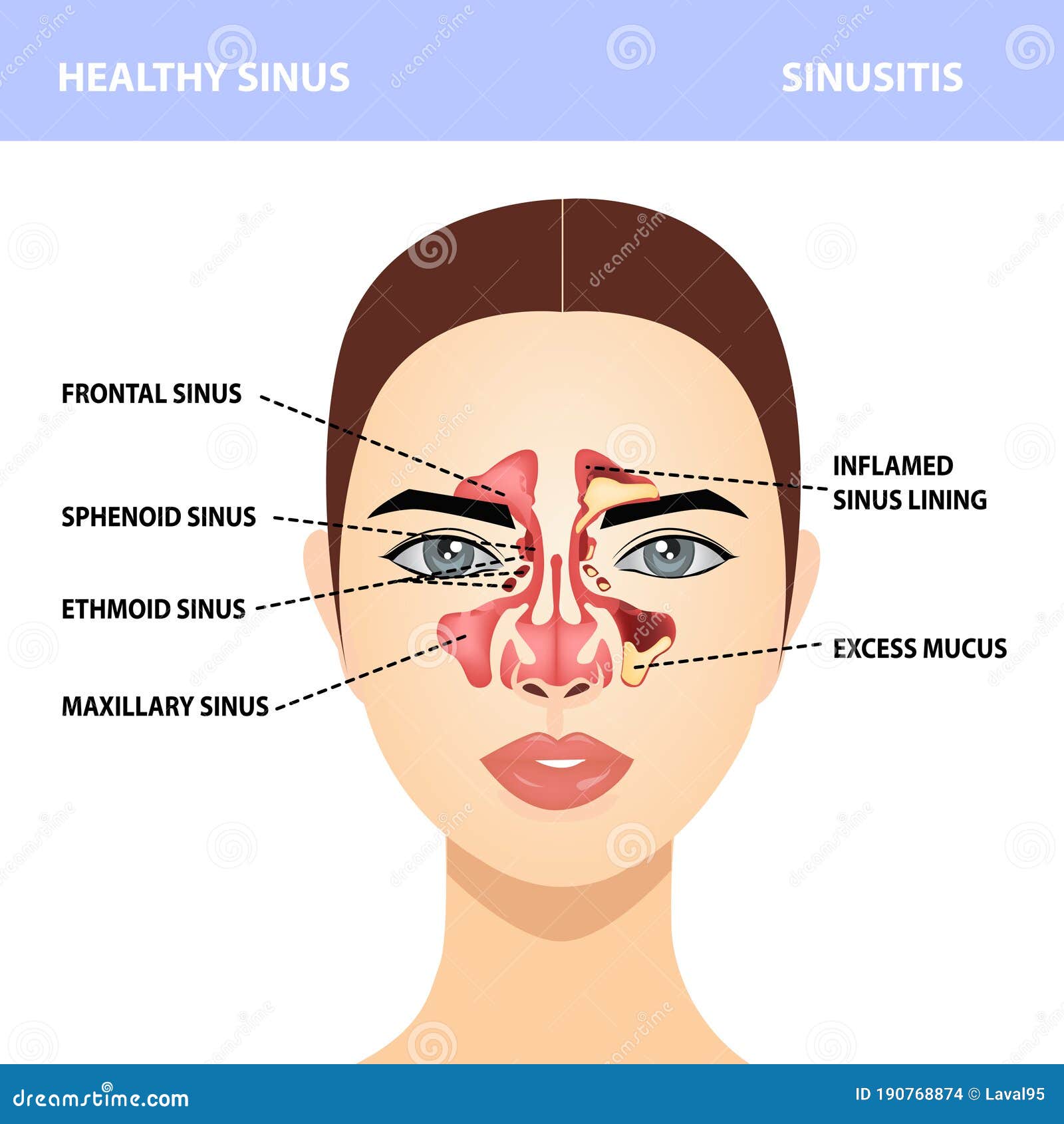 sinusitis. healthy and sinus infections, signs, realistic  for medical posters and educational materials