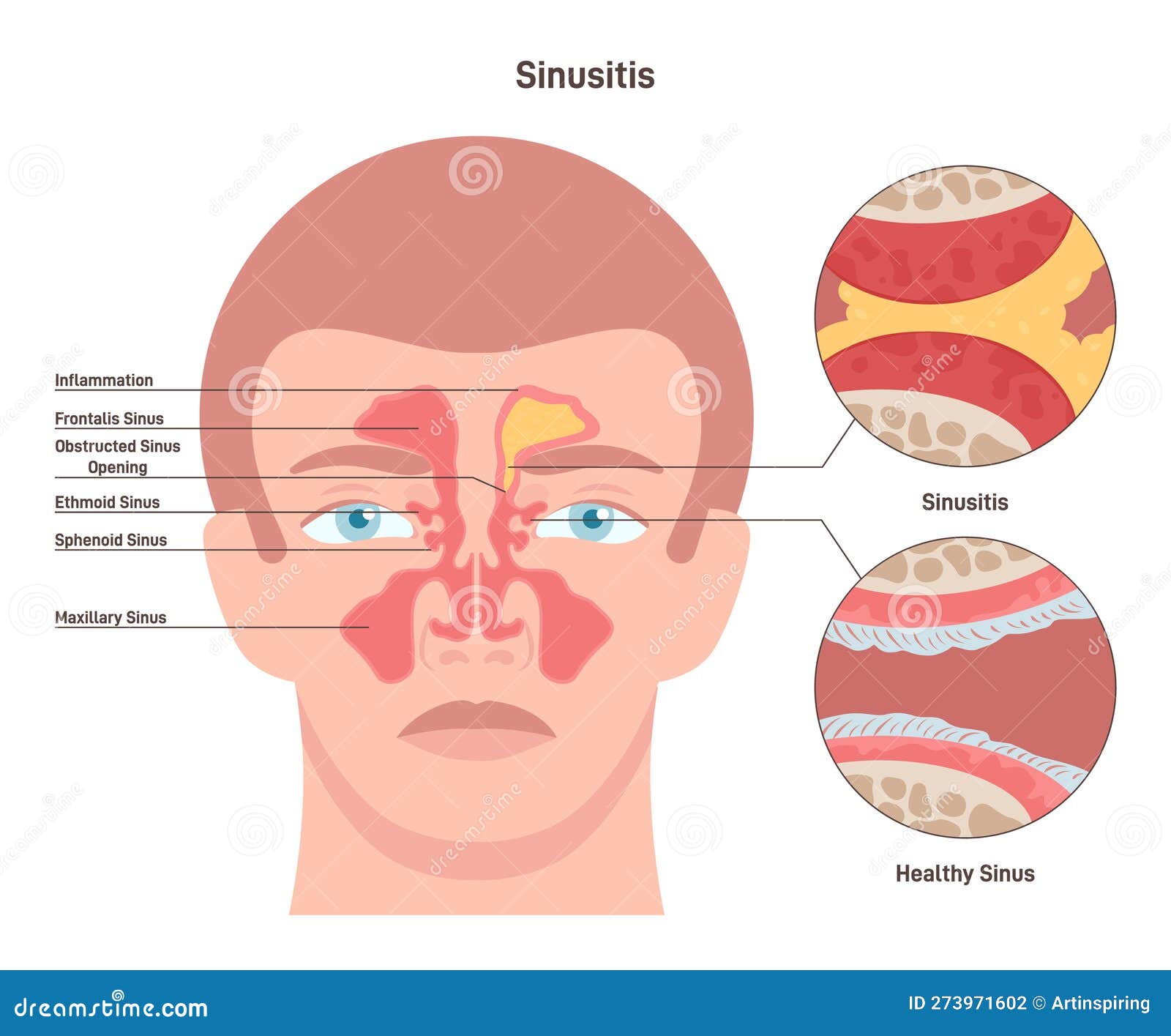 sinusitis. inflamed sinus with excess mucus and obstructed airways