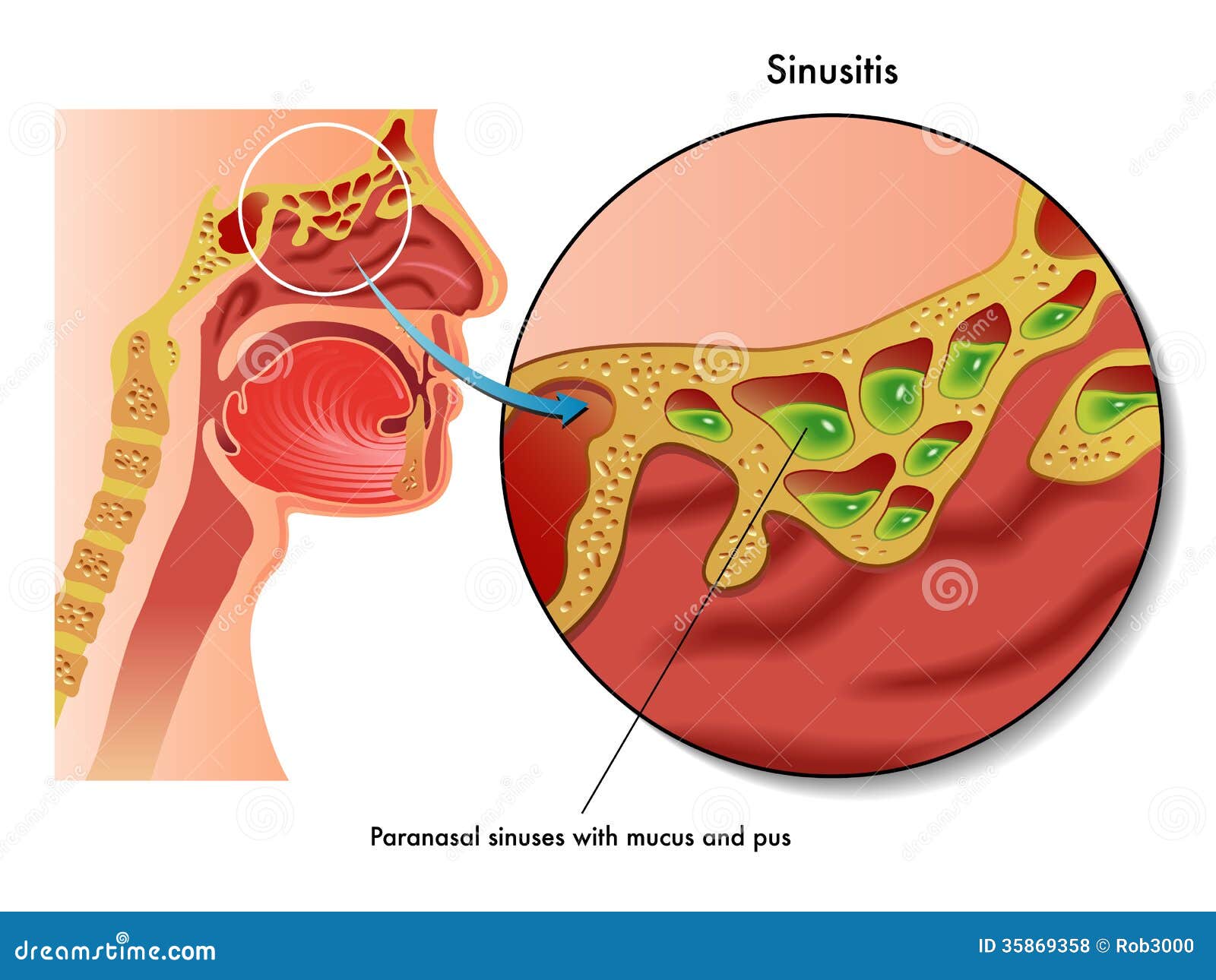 sinusitis