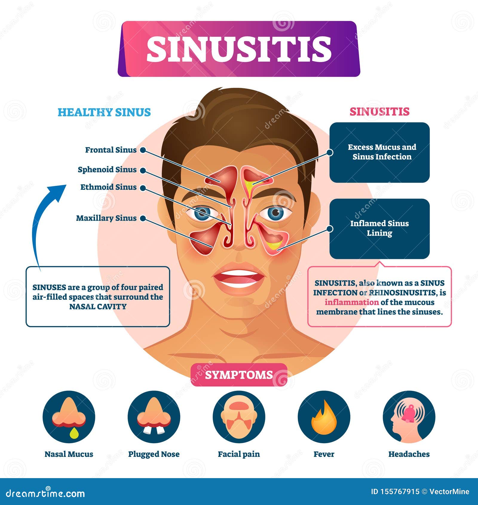 sinusitis  . labeled rhinosinusitis inflammation scheme.